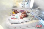 手掌嬰兒救治成功 山西最小早產(chǎn)兒